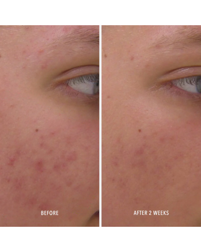 Сироватка HydroPeptide Clear Rescue із саліциловою кислотою для жирної та схильної до акне шкіри 30 мл
